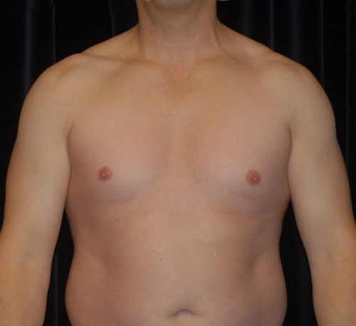 Male Body Contouring Before & After