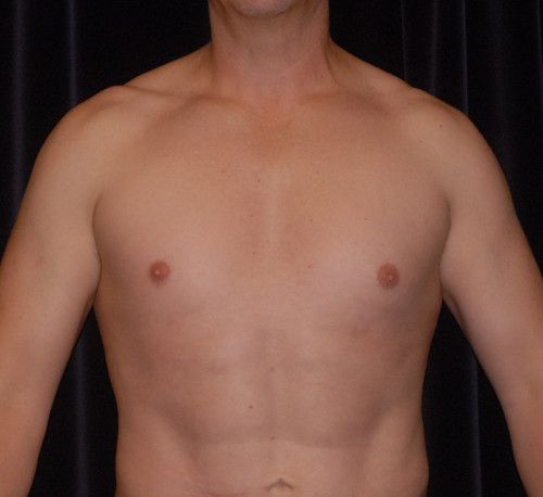 Male Body Contouring Before & After