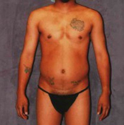 Male Body Contouring Before & After