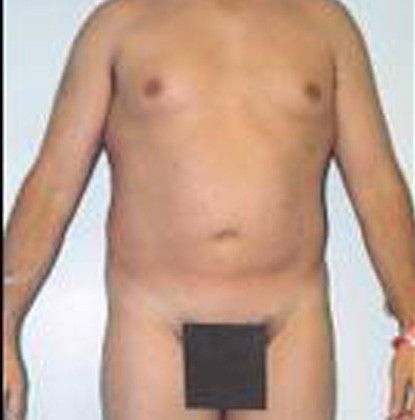 Male Body Contouring Before & After