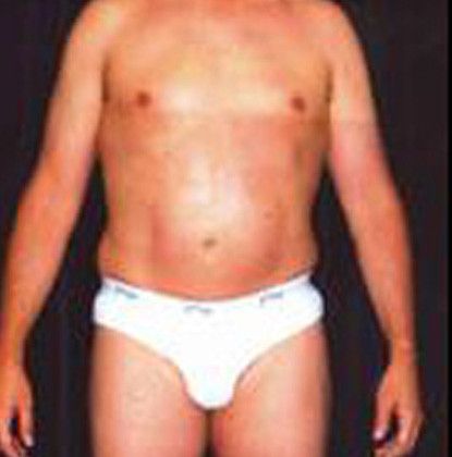 Male Body Contouring Before & After