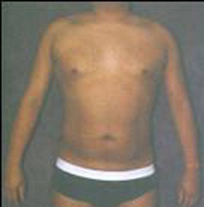 Male Body Contouring Before & After