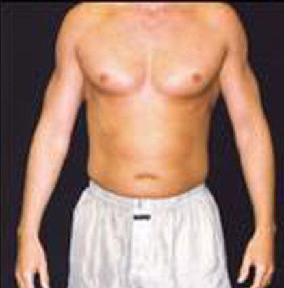 Male Body Contouring Before & After