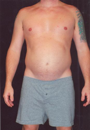 Male Body Contouring Before & After