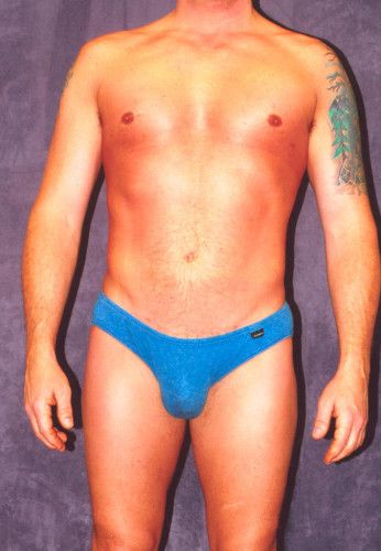 Male Body Contouring Before & After