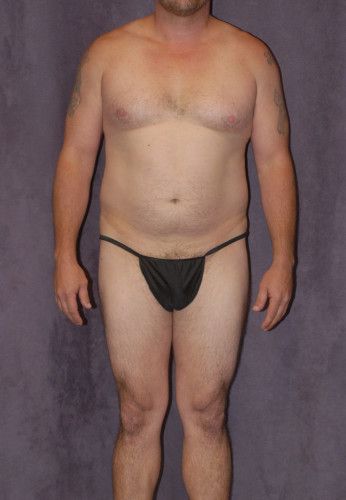 Male Body Contouring Before & After