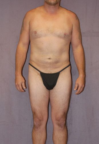 Male Body Contouring Before & After