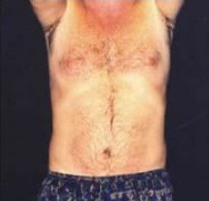 Male Body Contouring Before & After