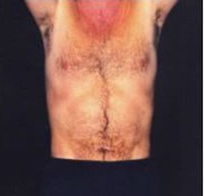 Male Body Contouring Before & After