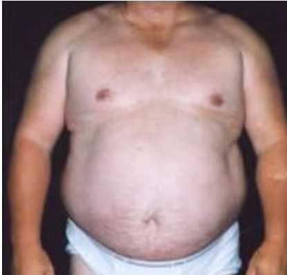 Male Body Contouring Before & After