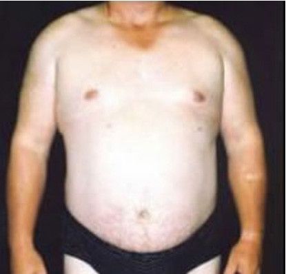 Male Body Contouring Before & After