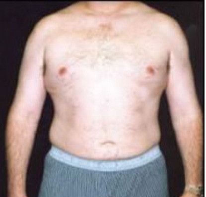 Male Body Contouring Before & After