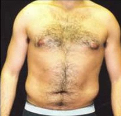 Male Body Contouring Before & After
