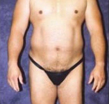 Male Body Contouring Before & After