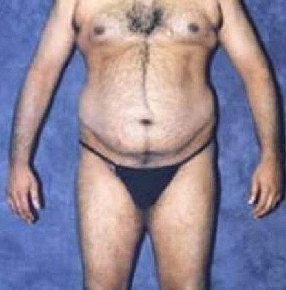 Male Body Contouring Before & After