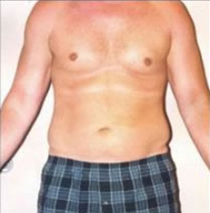 Male Body Contouring Before & After