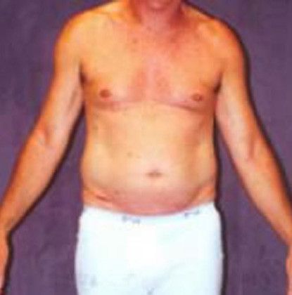 Male Body Contouring Before & After
