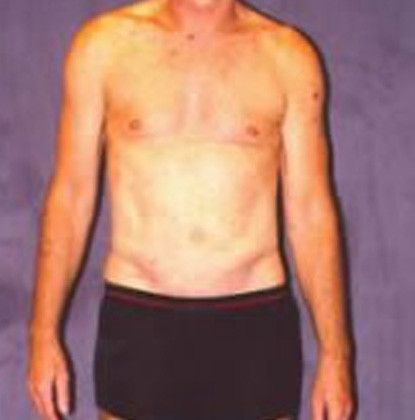 Male Body Contouring Before & After