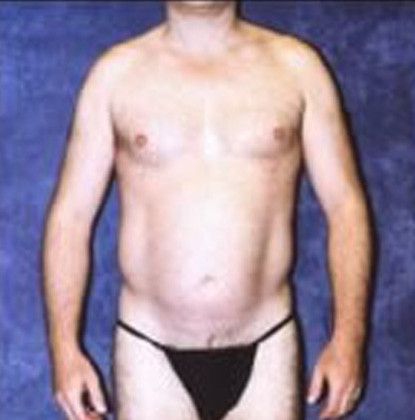 Male Body Contouring Before & After