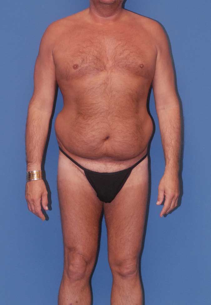 Male Body Contouring Before & After