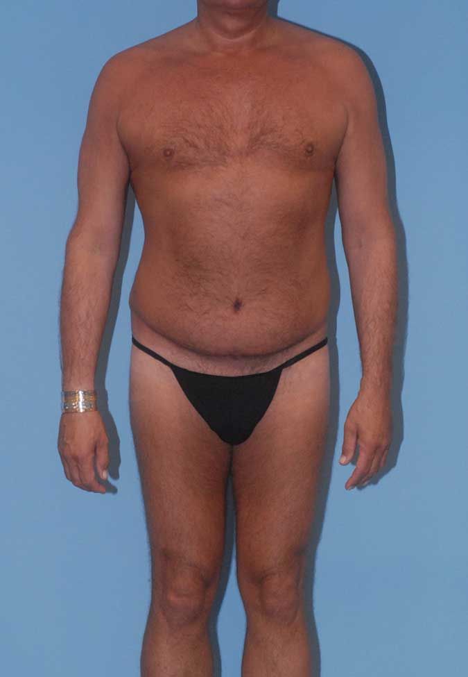 Male Body Contouring Before & After