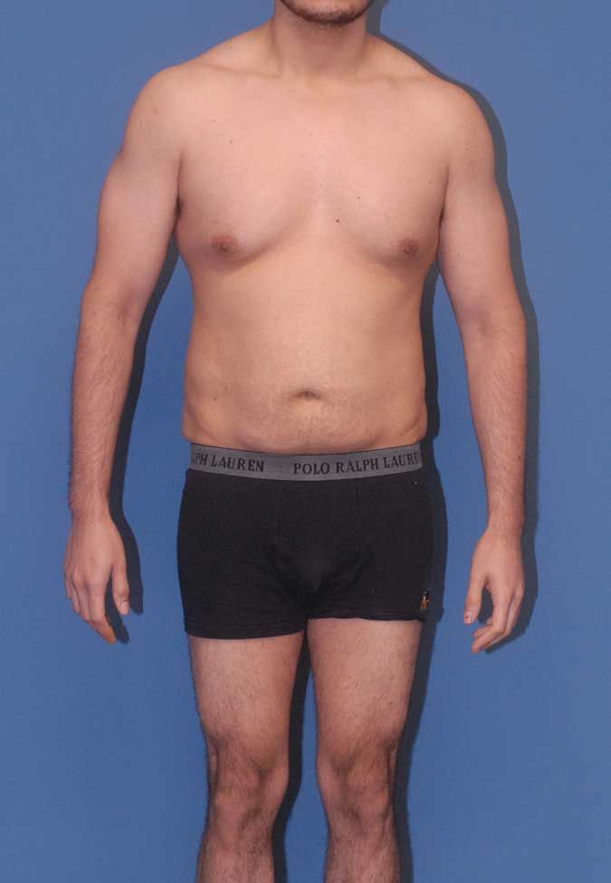 Male Body Contouring Before & After