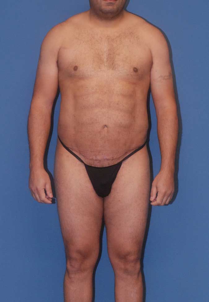 Male Body Contouring Before & After