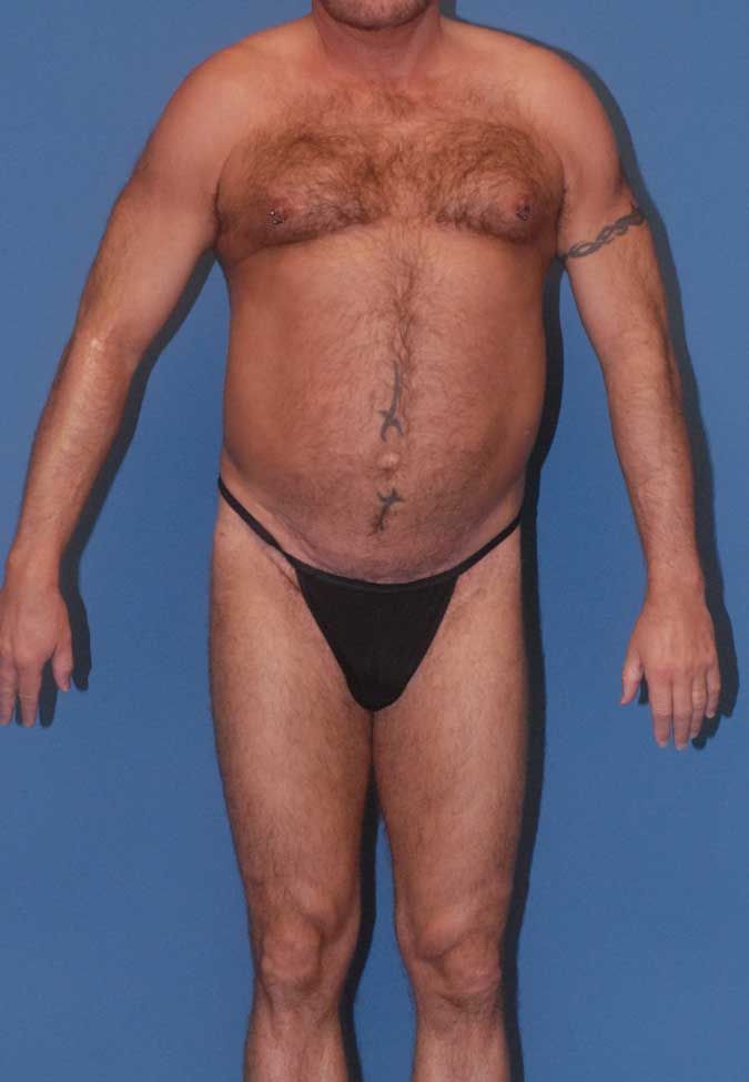 Male Body Contouring Before & After