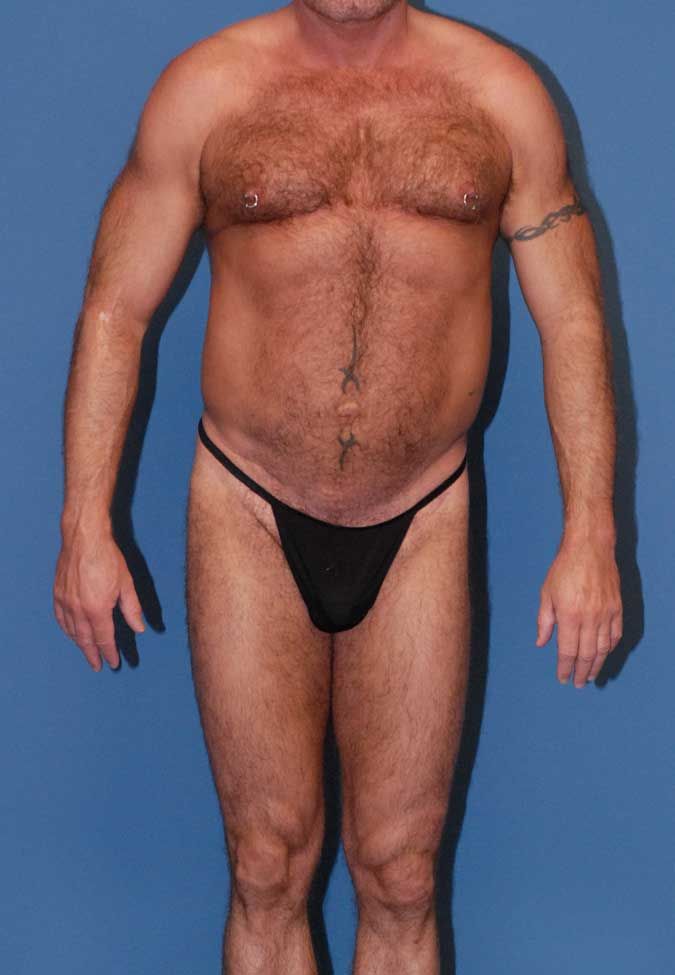 Male Body Contouring Before & After