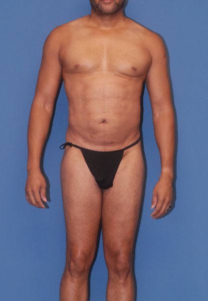 Male Body Contouring Before & After