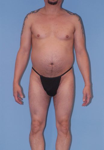 Male Body Contouring Before & After