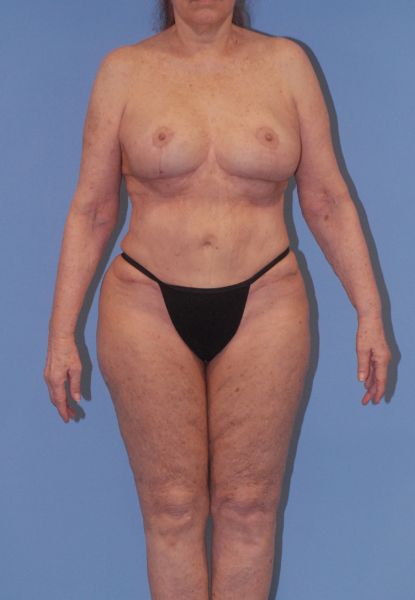 Female Body Contouring Before & After Image