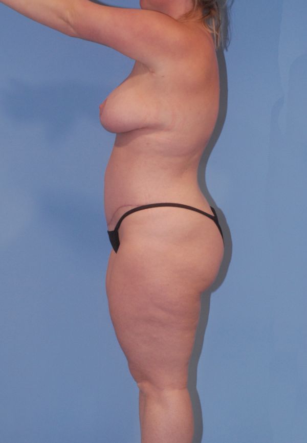 Female Body Contouring Before & After Image