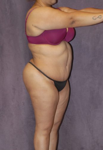 Liposuction  Before & After Image