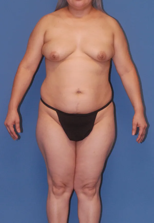 Fat Grafting to Breast Before & After Image