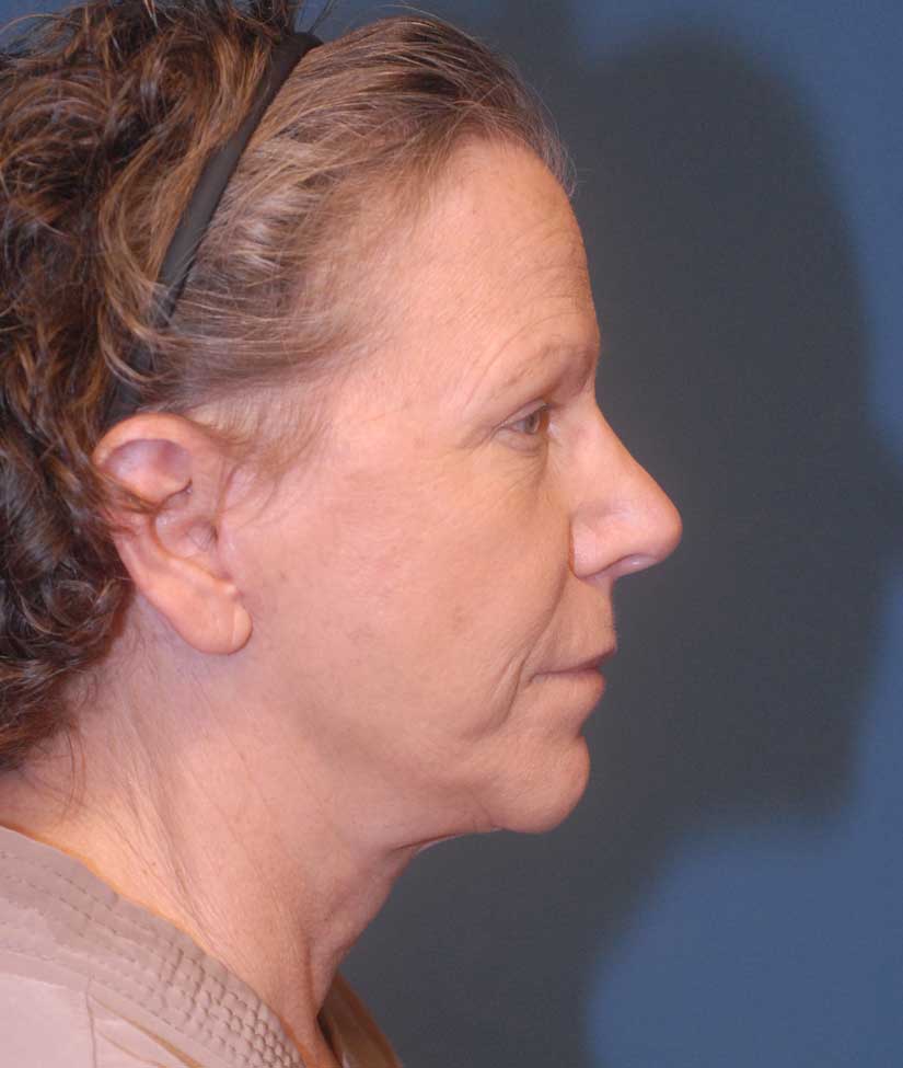 Female Facial Rejuvenation Before & After Image