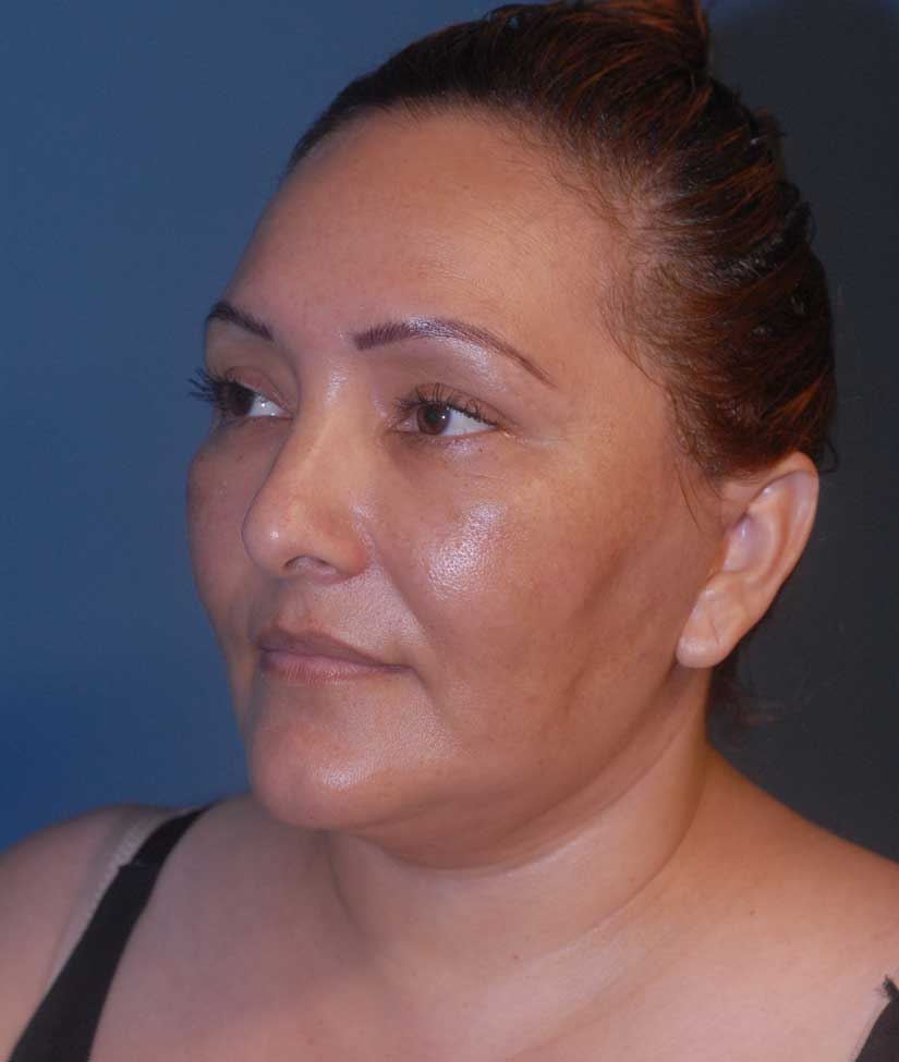 Facial Liposuction Before & After Image
