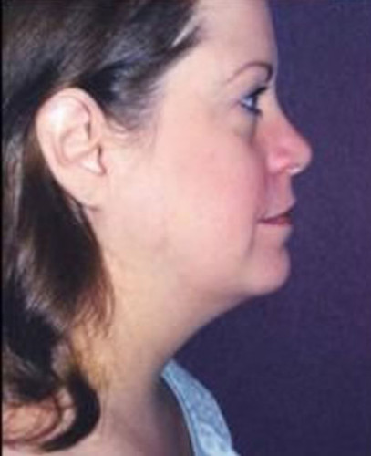 Facial Liposuction Before & After Image