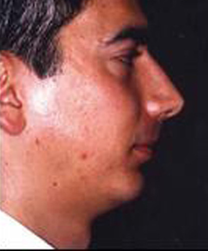 Male Facial Rejuvenation  Before & After Image