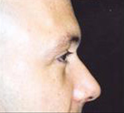 Male Facial Rejuvenation  Before & After Image