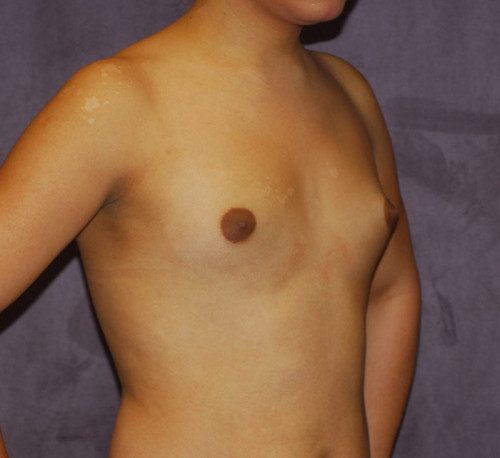 Male To Female Breast Contouring Before & After Image