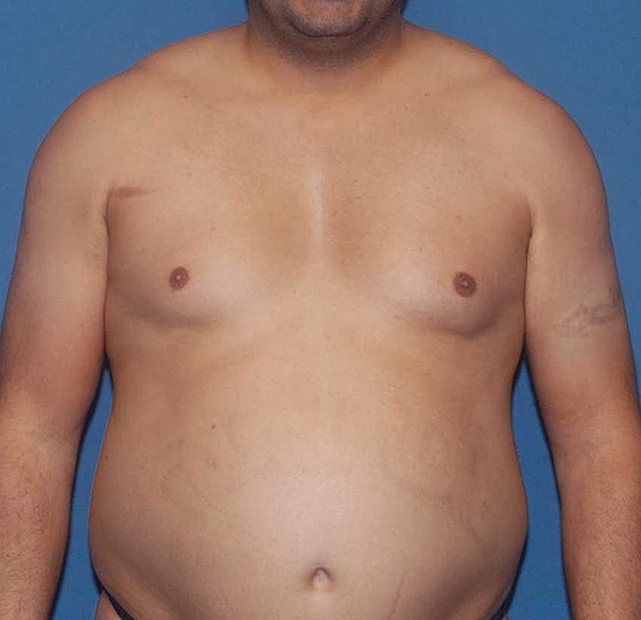 Man with exposed torso and slight abdominal protrusion.