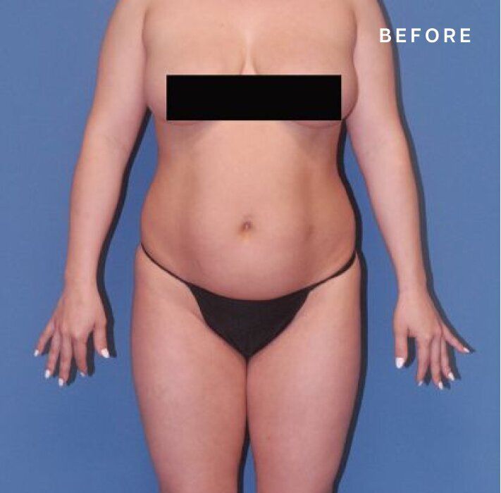 Before image of body transformation.