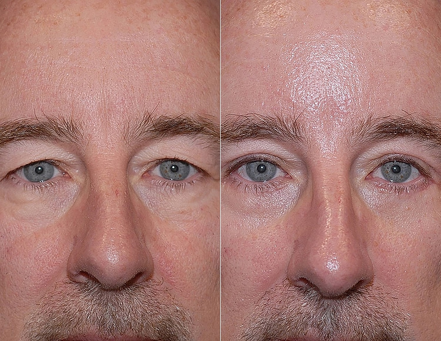 Before and after eye treatment comparison image.