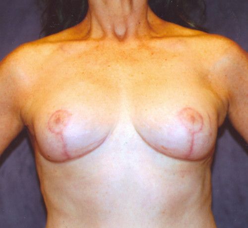 Breast Reduction And Lift Before & After