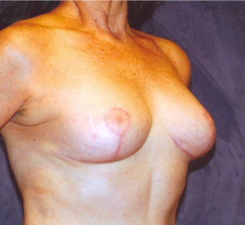Breast Reduction And Lift Before & After