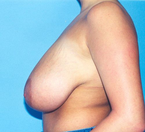 Breast Reduction And Lift Before & After