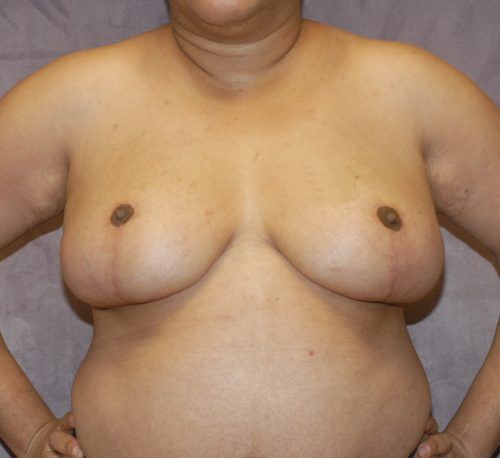 Breast Reduction And Lift Before & After
