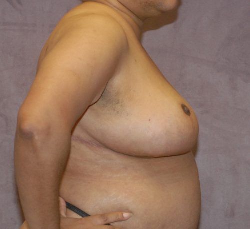 Breast Reduction And Lift Before & After