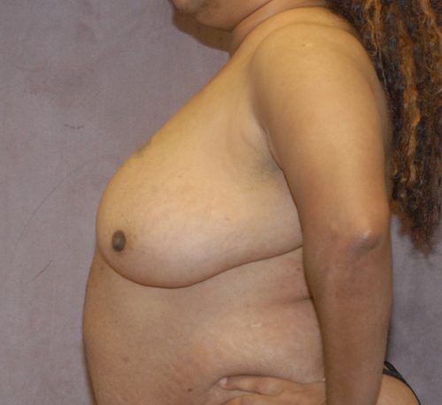 Breast Reduction And Lift Before & After